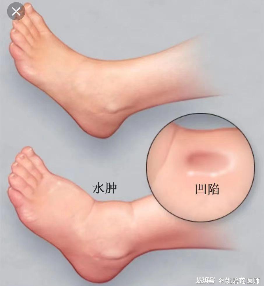水肿最新程度分级标准详解